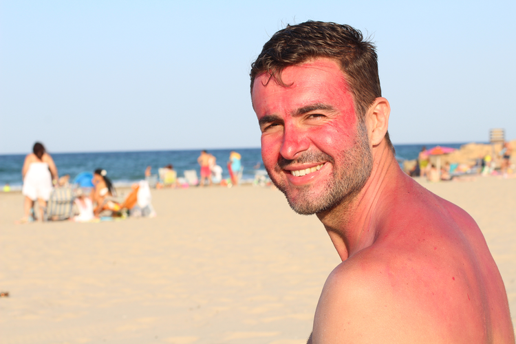Man at the beach with a sunburn.